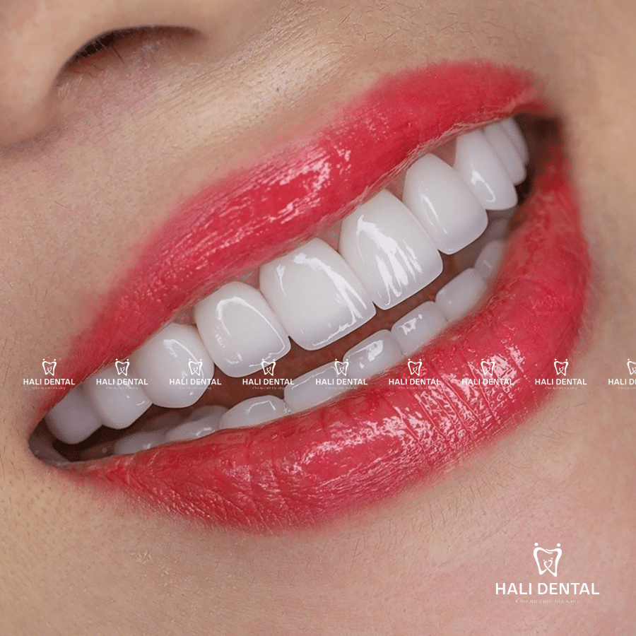 Răng sứ orodent white
