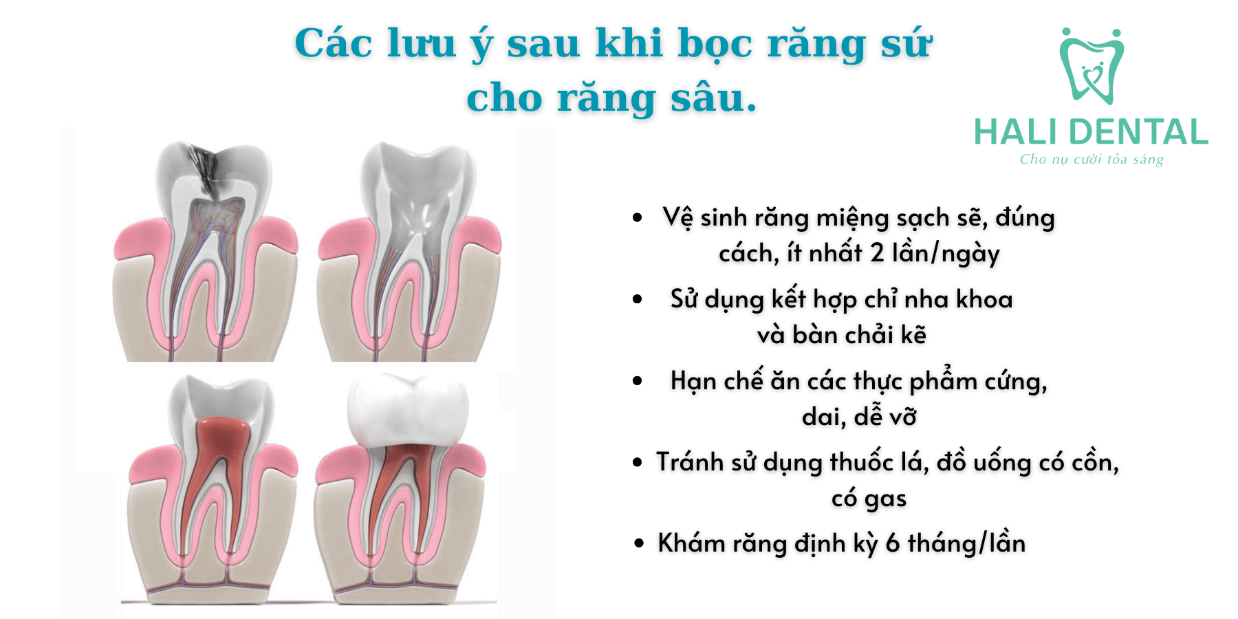 Các lưu ý sau khi bọc răng sứ cho răng sâu